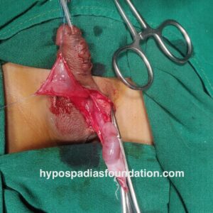 urethrocutaneous fistula repair using tunica vaginalis flap