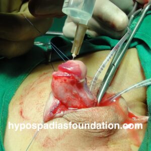 penoscrotal hypospadias with severe chordee and shortage of skin