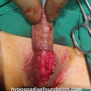 urethrocutaneous fistula repair using tunica vaginalis flap