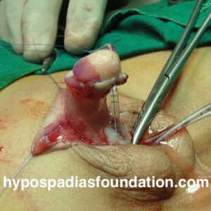 penoscrotal hypospadias with severe chordee and shortage of skin