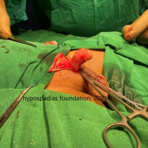 Staged Repair in Proximal Penile Hypospadias