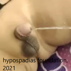 Staged Repair in Proximal Penile Hypospadias