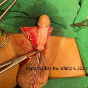 Staged Repair in Proximal Penile Hypospadias