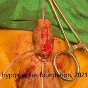 Staged Repair in Proximal Penile Hypospadias