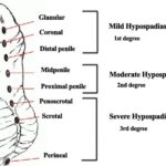 Hypospadias Guide for Pediatricians and Healthcare Professionals