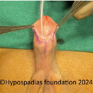 Single stage hypospadias repair in a child