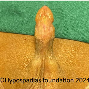 Single stage hypospadias repair in a child